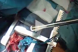 Anwendung EKA GmbH Infrarot-Lichtkoagulator Beispielvideo 02