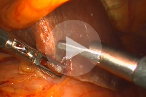 Anwendung EKA GmbH Infrarot-Lichtkoagulator Beispielvideo 04a